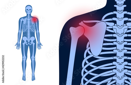 Shoulder pain concept