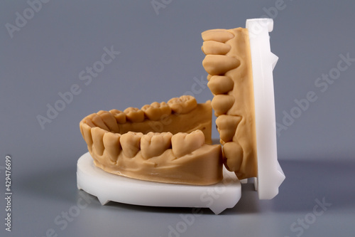 Mold of teeth. Gypsum model plaster of teeth. Stomatologic plaster cast, molds of human jaws and teeth on gray background. Dentistry and orthodontics concept photo