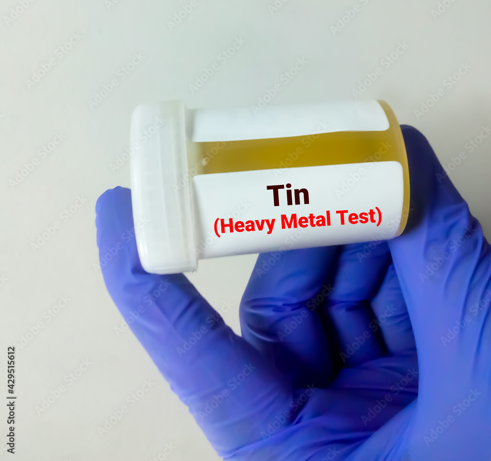 Urine sample for (heavy metal) test, toxic metal.Diagnosis of Tin