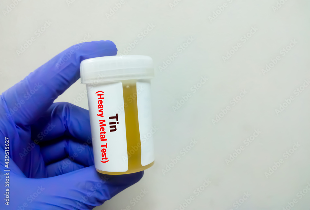 Urine sample for (heavy metal) test, toxic metal.Diagnosis of Tin