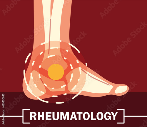 rheumatology ankle bones