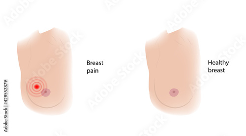 Woman healthy breast and pain. Comparison. Medical vector illustration.