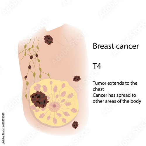 Woman breast. Cancer T4 Tumor extends to the chest spread to other areas of the body view with description. Medical vector illustration.