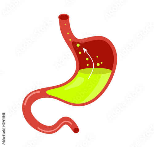 Bild auf Leinwand Acid reflux or gastroesophageal reflux, Heartburn