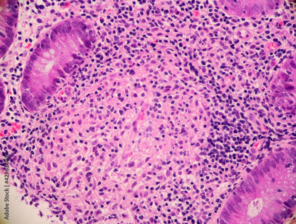 Chronic colitis with a granuloma surrounded by numerous immune cells
