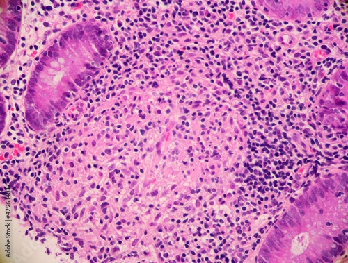 Chronic colitis with a granuloma surrounded by numerous immune cells, including small dark lymphocytes, in a colon biopsy from a patient with Crohn's disease. Microscopic view.