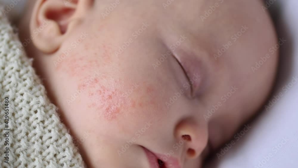 atopic dermatitis allergic skin red rash pimples on baby's cheek face close-up view atopic dermatitis allergic skin red rash pimples on baby's cheek face close-up view