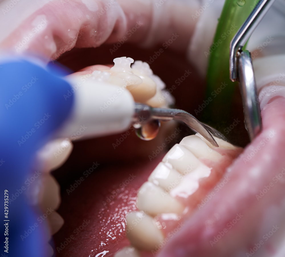 Obraz premium Close up of orthodontist using dental tools while cleaning teeth of patient. Woman with cheek retractor in mouth and braces on teeth receiving dental treatment. Concept of professional dental hygiene