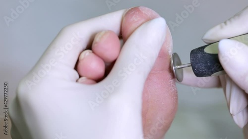 Treatment of the foot of a diabetic patient, removal of rough dry skin from the heel. Problematic diabetic foot with cracks in a woman. Medical hardware pedicure in the salon.