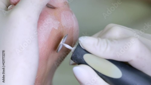 Treatment of the foot of a diabetic patient, removal of rough dry skin from the heel. Problematic diabetic foot with cracks in a woman. Medical hardware pedicure in the salon.
