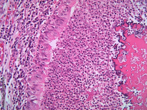 A lung bronchiole lined by ciliated epithelium and filled with massive acute inflammation and thickened mucus at right. Patient with Cystic fibrosis. Microscopic view.