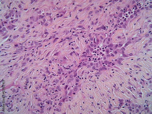 Microscopic view of Mesothelioma cancer cells infiltrating the beige fibrous lung pleura.