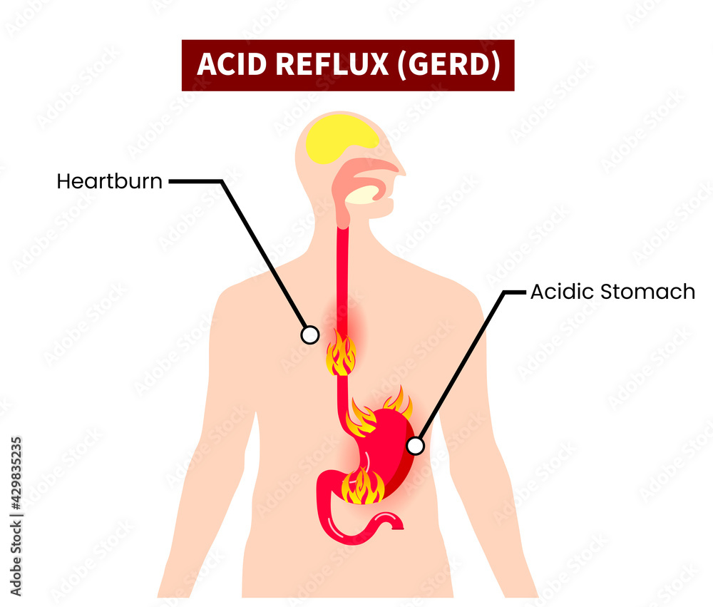 GERD, Acid Reflux Human stomach esophagus on fire gastroesophageal ...