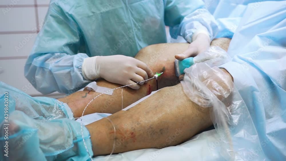 Doctor is performing medical procedure. Endovasal (endovenous) laser coagulation (obliteration) is used to eliminate varicose veins. Insertion of laser with luminous tip directly into vein. Doctor is performing medical procedure. Endovasal (endovenous) laser coagulation (obliteration) is used to eliminate varicose veins. Insertion of laser with luminous tip directly into vein.