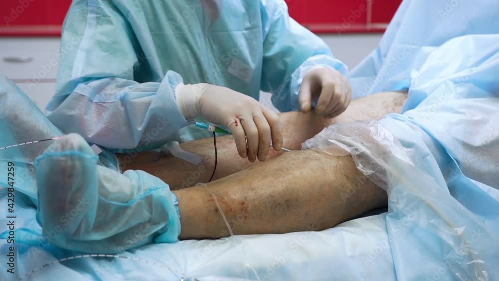 Doctor is performing medical procedure. Endovasal (endovenous) laser coagulation (obliteration) is used to eliminate varicose veins. Insertion of laser with luminous tip directly into vein. Doctor is performing medical procedure. Endovasal (endovenous) laser coagulation (obliteration) is used to eliminate varicose veins. Insertion of laser with luminous tip directly into vein.