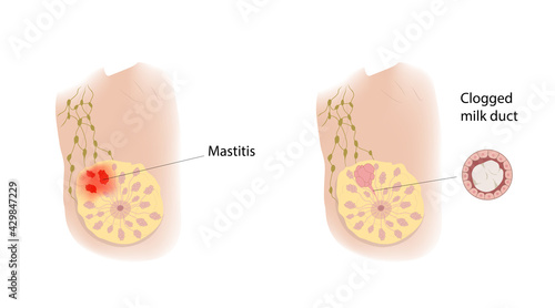 Woman breast. Mastitis and Clogged milk duct. Comparison. Medical vector illustration.