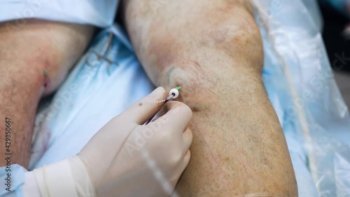 Endovenous laser ablation (EVLA) is a commonly used and very effective minimally invasive therapy to manage leg varicosities.