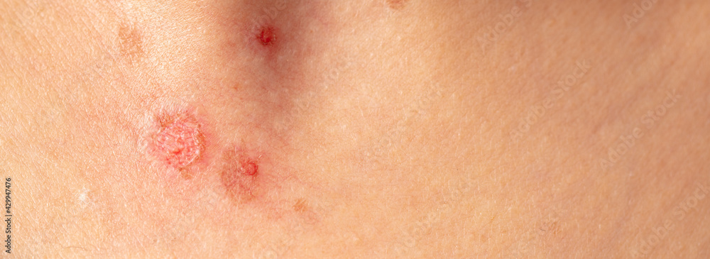 Fototapeta premium Burn wound on human skin.