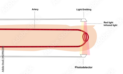 Principle of reading pulse oximeter. Components of a pulse oximeter sensor. Emission of light through blood capillaries oximetry photo