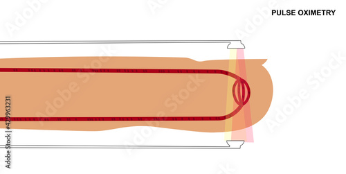 Principle of reading pulse oximeter. Emission of light through blood capillaries