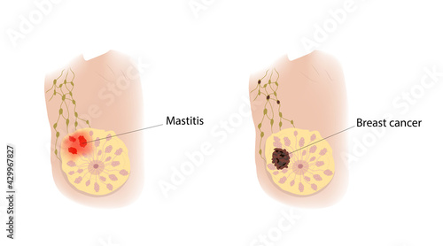 Woman breast. Mastitis and cancer. Comparison. Medical vector illustration.