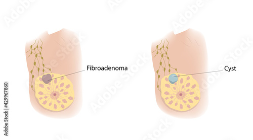 Woman breast. Cyst and Fibroadenoma. Comparison. Medical vector illustration.