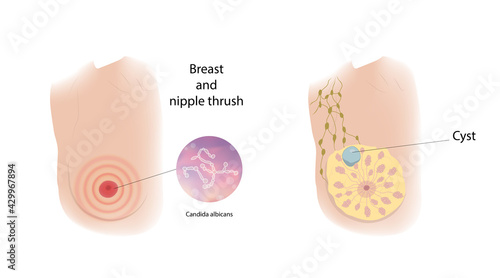 Woman breast and nipple thrush, cyst. Comparison. Medical vector illustration.