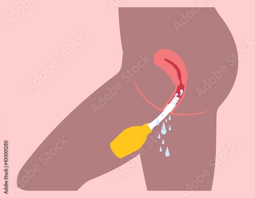 Douche vagina odor clean blood flora ectopic yeast bacterial Pelvic genitals swelling pain sex hygiene system microbes allergic cycle health problem tract prevent mucus Cervical cervix itching cancer