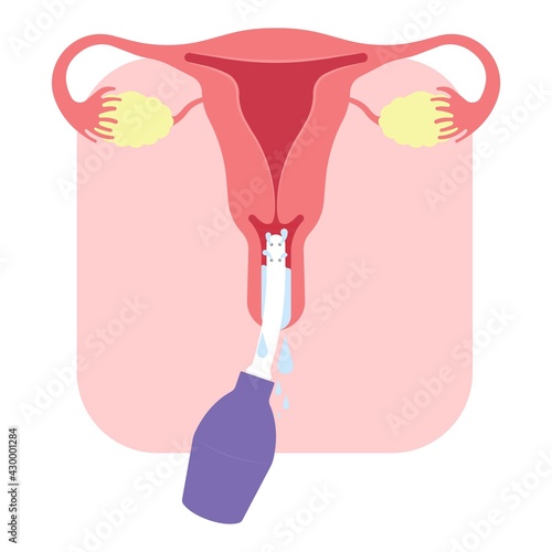 Douche vagina odor clean blood flora ectopic yeast bacterial Pelvic genitals swelling pain sex hygiene system microbes allergic cycle health problem tract prevent mucus Cervical cervix itching cancer