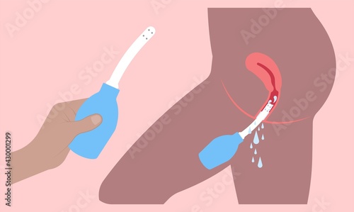 Douche vagina odor clean blood flora ectopic yeast bacterial Pelvic genitals swelling pain sex hygiene system microbes allergic cycle health problem tract prevent mucus Cervical cervix itching cancer