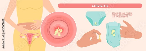 Douche vagina odor clean blood flora ectopic yeast bacterial Pelvic genitals swelling pain sex hygiene system microbes allergic cycle health problem tract prevent mucus Cervical cervix itching cancer