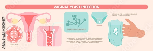 Douche vagina odor clean blood flora ectopic yeast bacterial Pelvic genitals swelling pain sex hygiene system microbes allergic cycle health problem tract prevent mucus Cervical cervix itching cancer