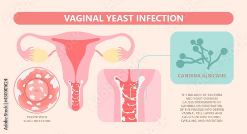 Douche vagina odor clean blood flora ectopic yeast bacterial Pelvic genitals swelling pain sex hygiene system microbes allergic cycle health problem tract prevent mucus Cervical cervix itching cancer