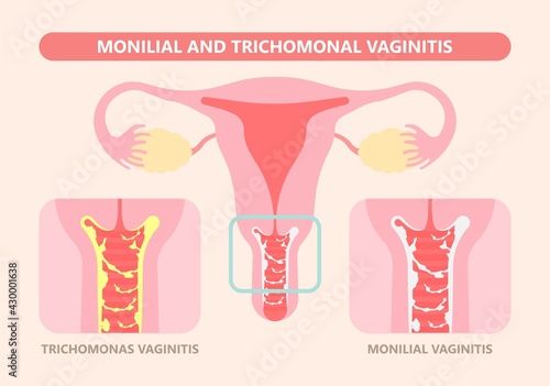 Douche vagina odor clean blood flora ectopic yeast bacterial Pelvic genitals swelling pain sex hygiene system microbes allergic cycle health problem tract prevent mucus Cervical cervix itching cancer