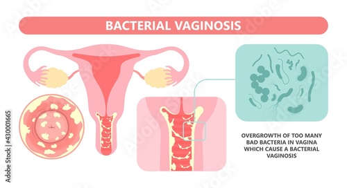 Douche vagina odor clean blood flora ectopic yeast bacterial Pelvic genitals swelling pain sex hygiene system microbes allergic cycle health problem tract prevent mucus Cervical cervix itching cancer