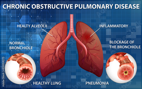 Lung with chronic obstructive pulmonary disease