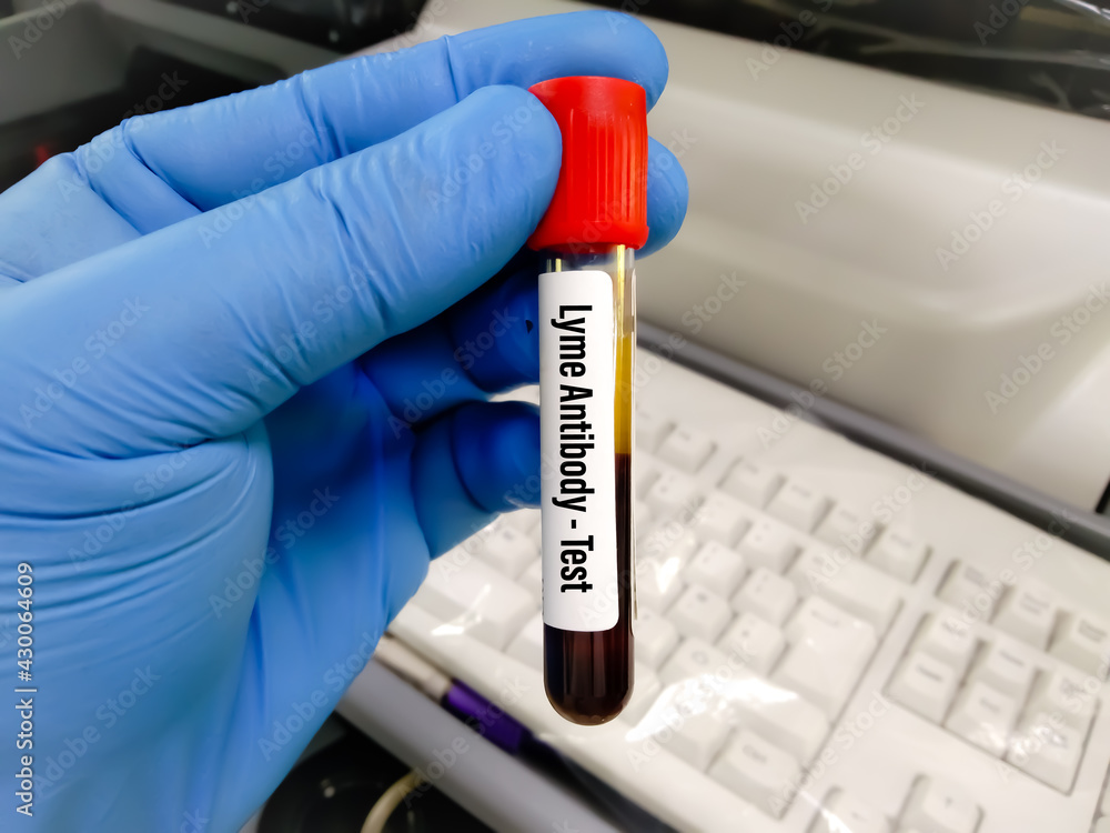 Blood sample tube for Creatinine test at medical laboratory Stock Photo