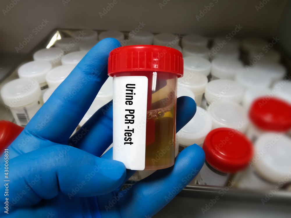 Foto de Urine Sample for Urine PCR(ProteinCreatinine Ratio).lab test