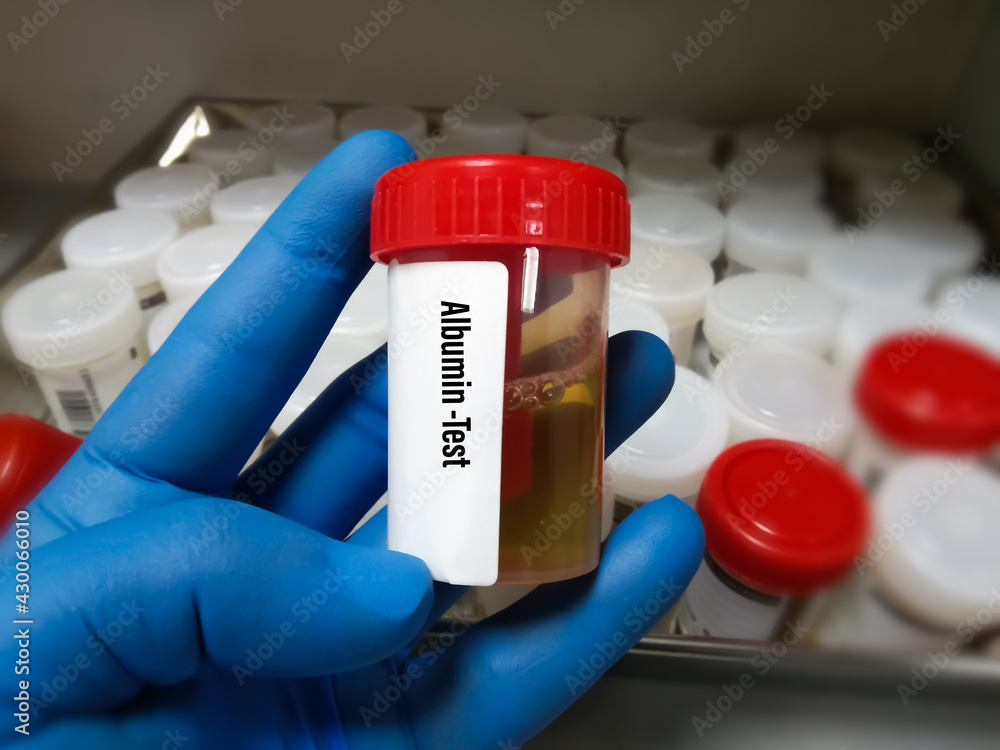 Urine Sample for Urine PCR(ProteinCreatinine Ratio).lab test of