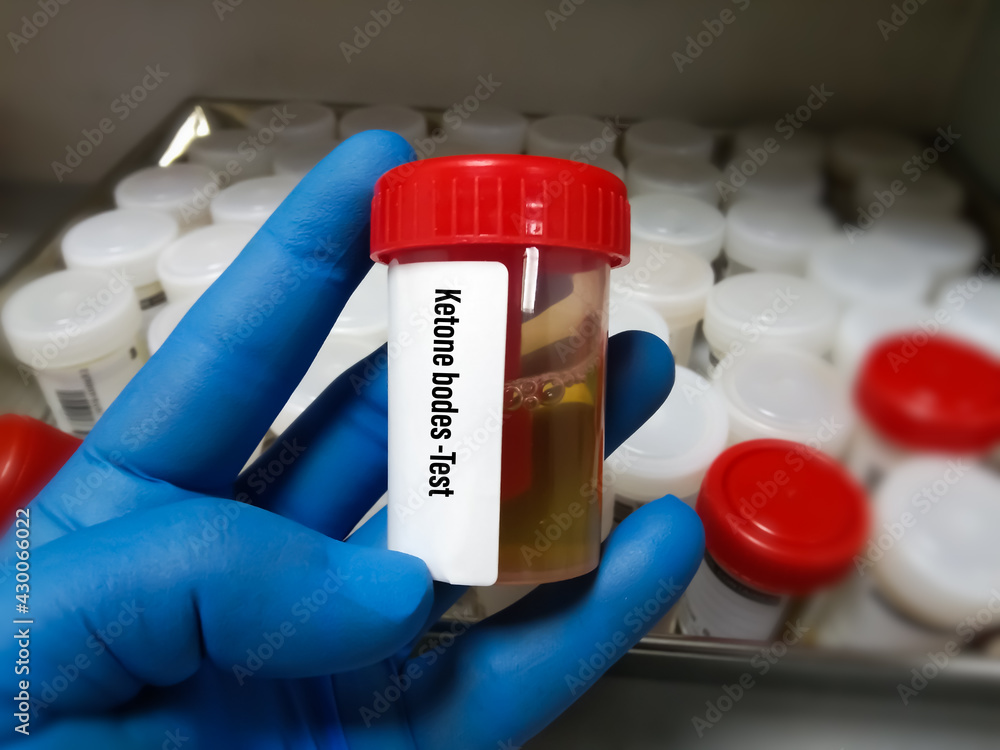 Urine Sample for Urine PCR(ProteinCreatinine Ratio).lab test of