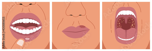 Canker sore, cold sore and sore throat. Vector illustration of aphthous ulcer, herpes and bacterial tonsillitis.