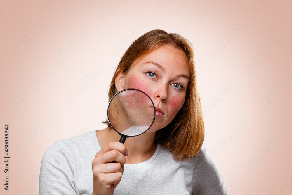 Portrait of a woman showing redness on her cheeks, through a magnifying glass. Pink background. The concept of rosacea Portrait of a woman showing redness on her cheeks, through a magnifying glass. Pink background. The concept of rosacea