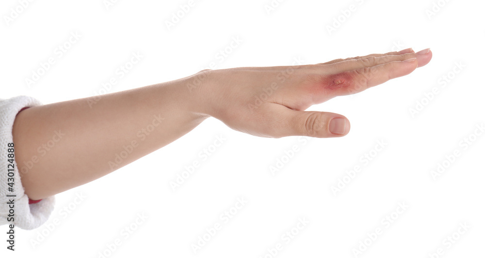 Woman with burn of her hand on white background, closeup Woman with burn of her hand on white background, closeup