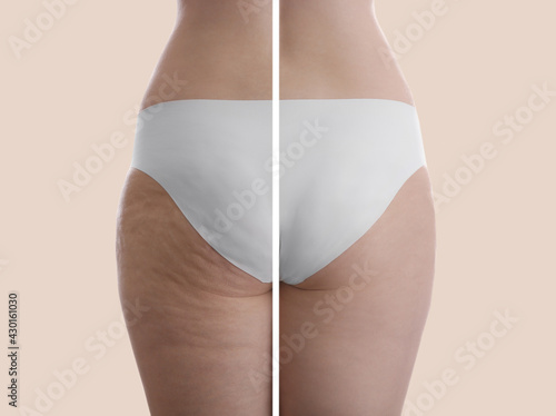 Collage with photos of woman before and after anti cellulite treatment on beige background,