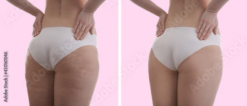 Collage with photos of woman before and after anti cellulite treatment on pink background,