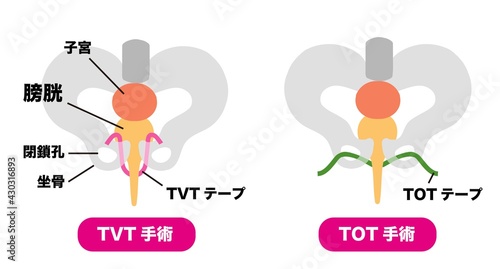 尿漏れ　TVT手術とTOT手術のメディカルイラスト素材