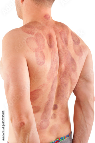 Suction cup marks on man's back. photo