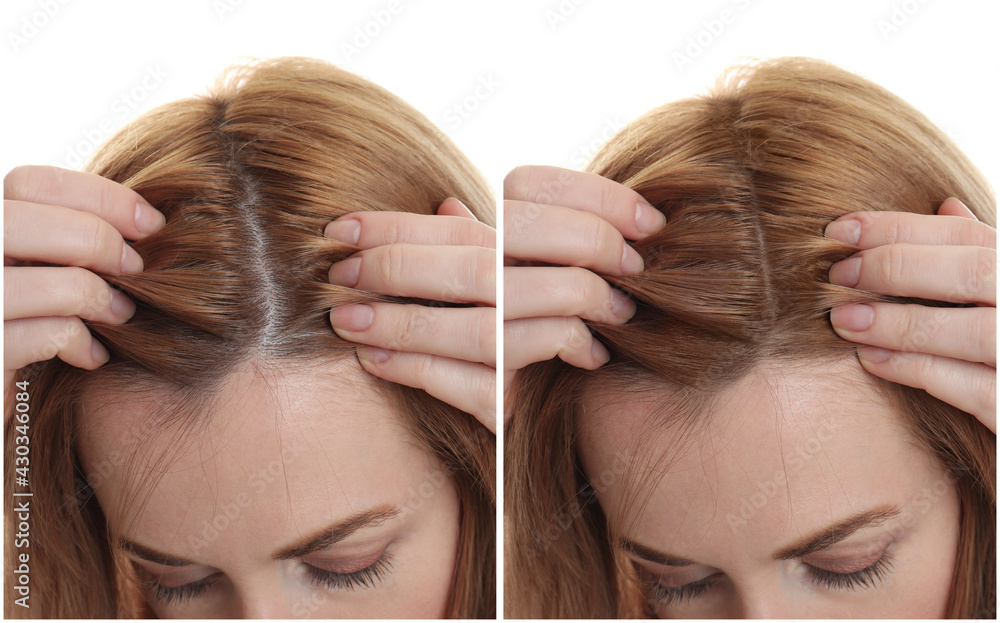 Naklejka premium Woman suffering from baldness on white background, closeup. Collage with photos before and after treatment
