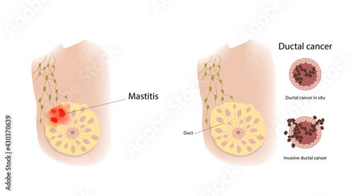 Woman breast. Mastitis and ductal cancer. Comparison. Medical vector illustration.