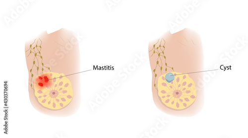 Woman breast. Mastitis and cyst. Comparison. Medical vector illustration.